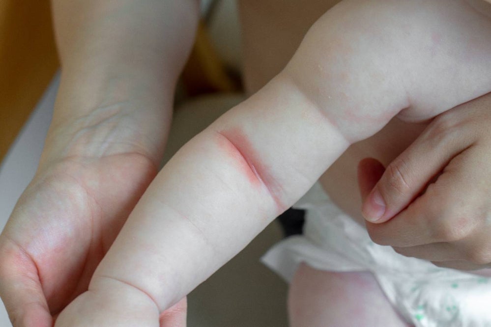 Baby's arm with eczema in the elbow crease
